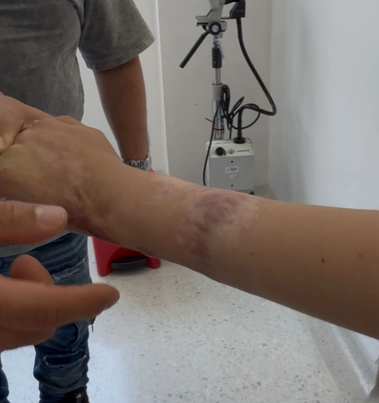 En el Hospital San Jorge se logró salvar el brazo de niño que sufrió un grave accidente
