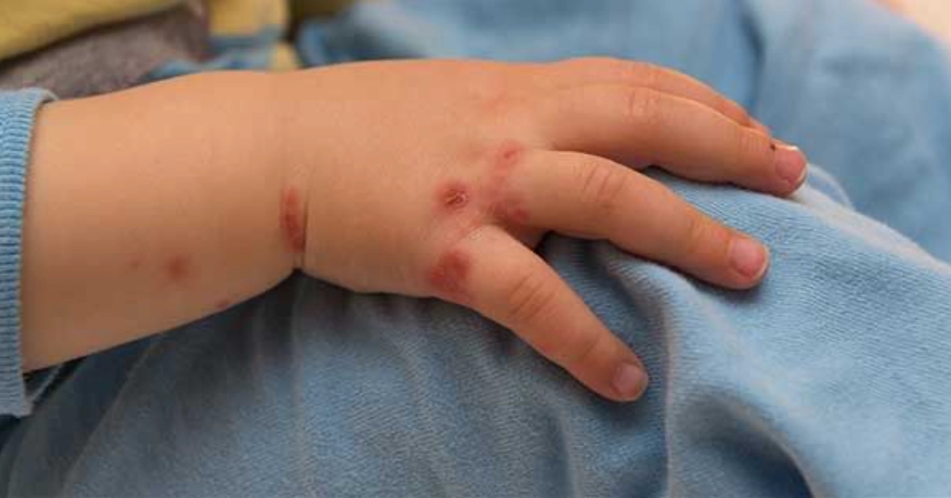 Autoridades de Dosquebradas hacen recomendaciones frente al brote de Kowalski